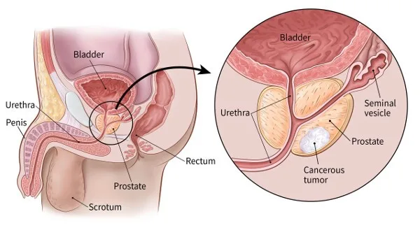  Prostate: Uko ukora, indwara z'iyifata n'uburyo bwo kwirinda